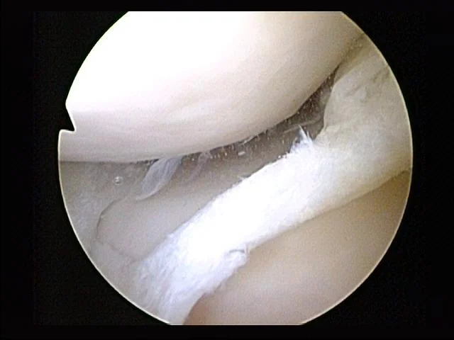 Arthroscopic camera view of a torn meniscus inside the knee
