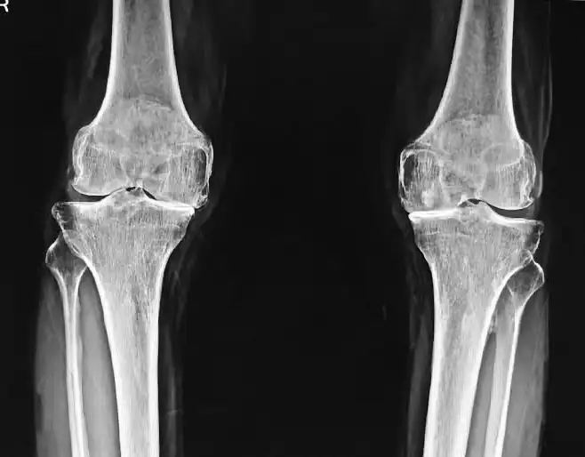 Standing X-ray of both knees showing osteoarthritis with narrowed joint space