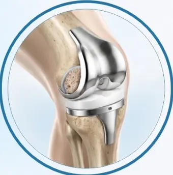 Illustration of a knee replacement implant