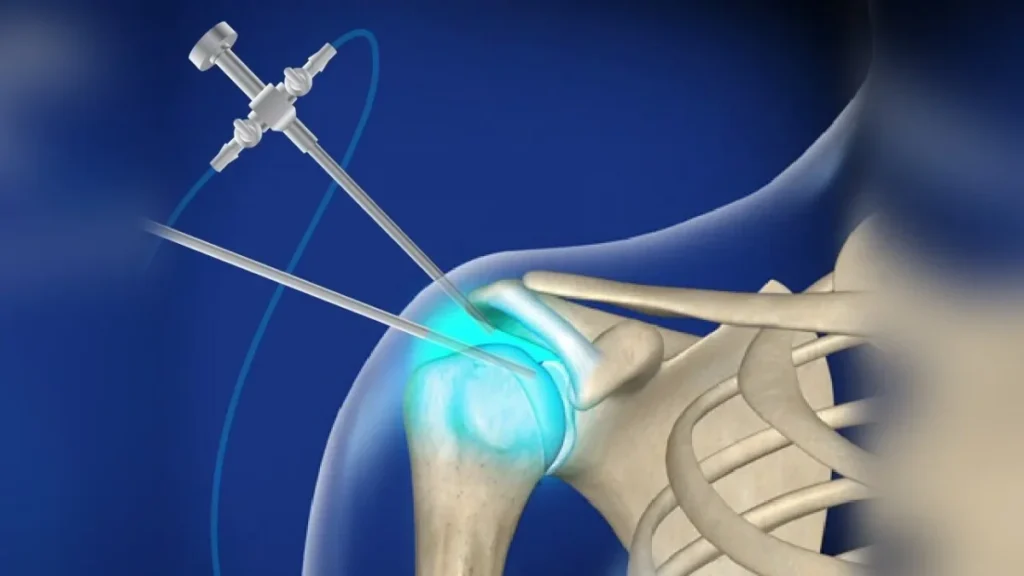 Illustration of arthroscopic shoulder surgery